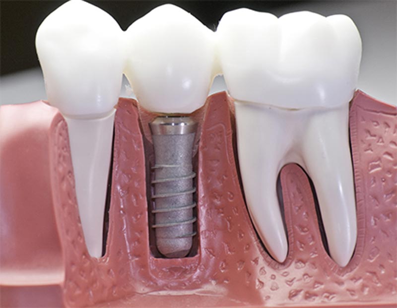 image-Loose-Dental-Implants